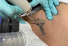 Tattoo Laser Removal